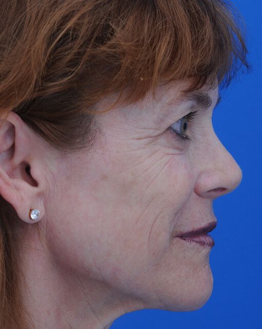 Postop Rev Rhinoplasty 3