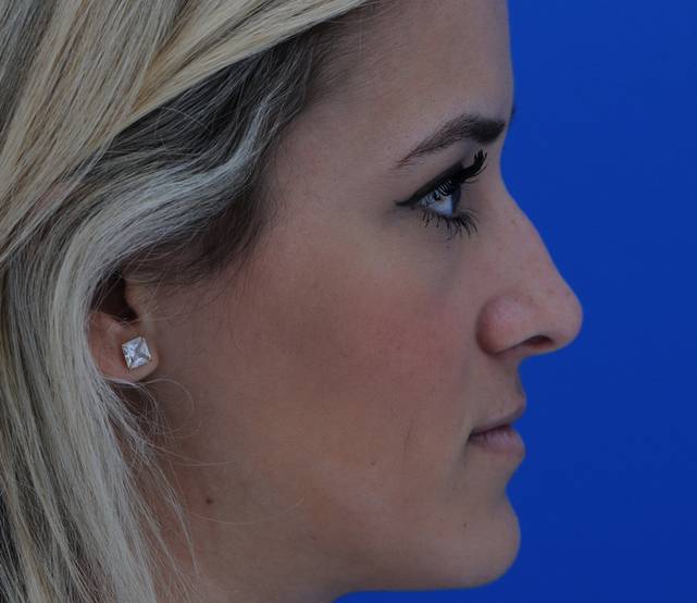 Liquid Rhinoplasty Side Before