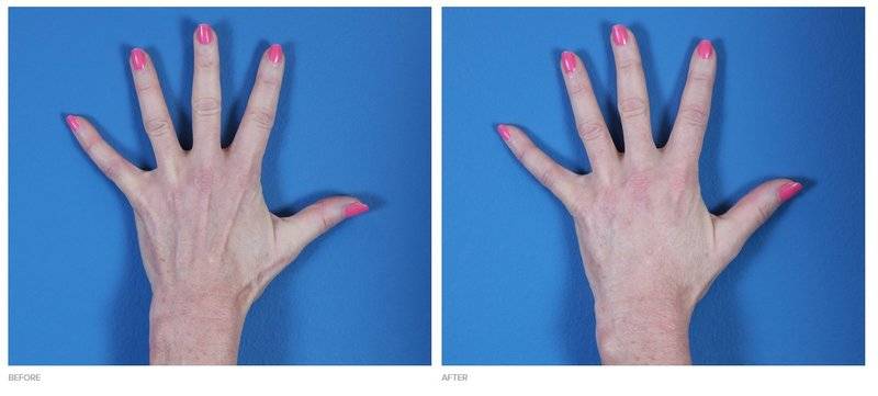 before and after radiesse