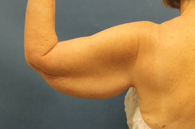 before arm lift