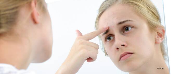 acne scar treatments