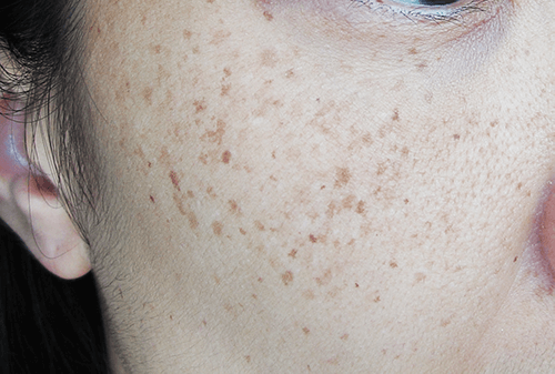 freckles