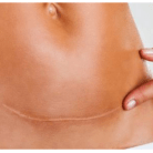 surgical incision