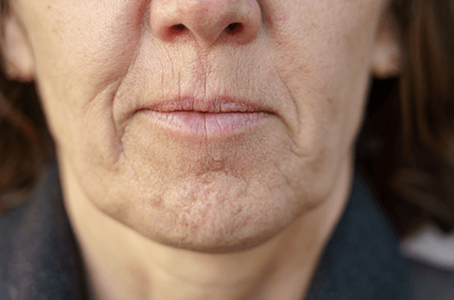 lip lines