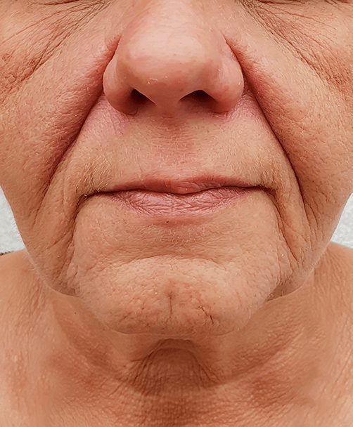 nasolabial folds