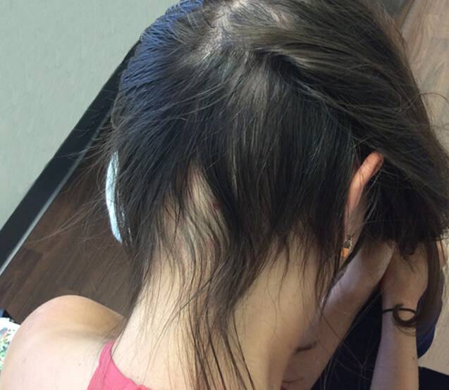 after proplasma hair restoration