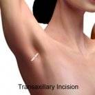 breast lift scar