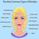 facial wrinkles