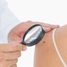 mole or skin tag