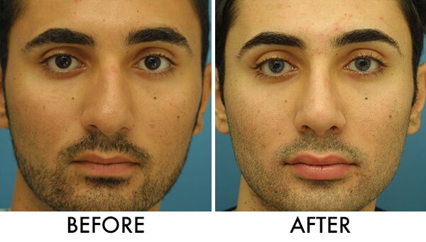 c-shaped nose correction