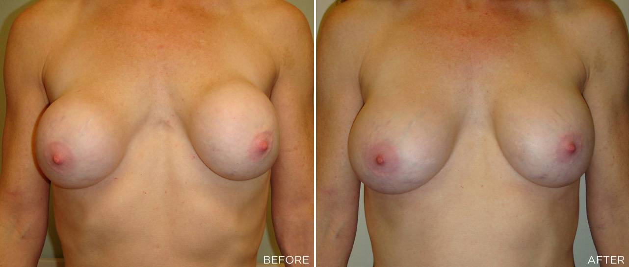 Patient E - Implant Revision