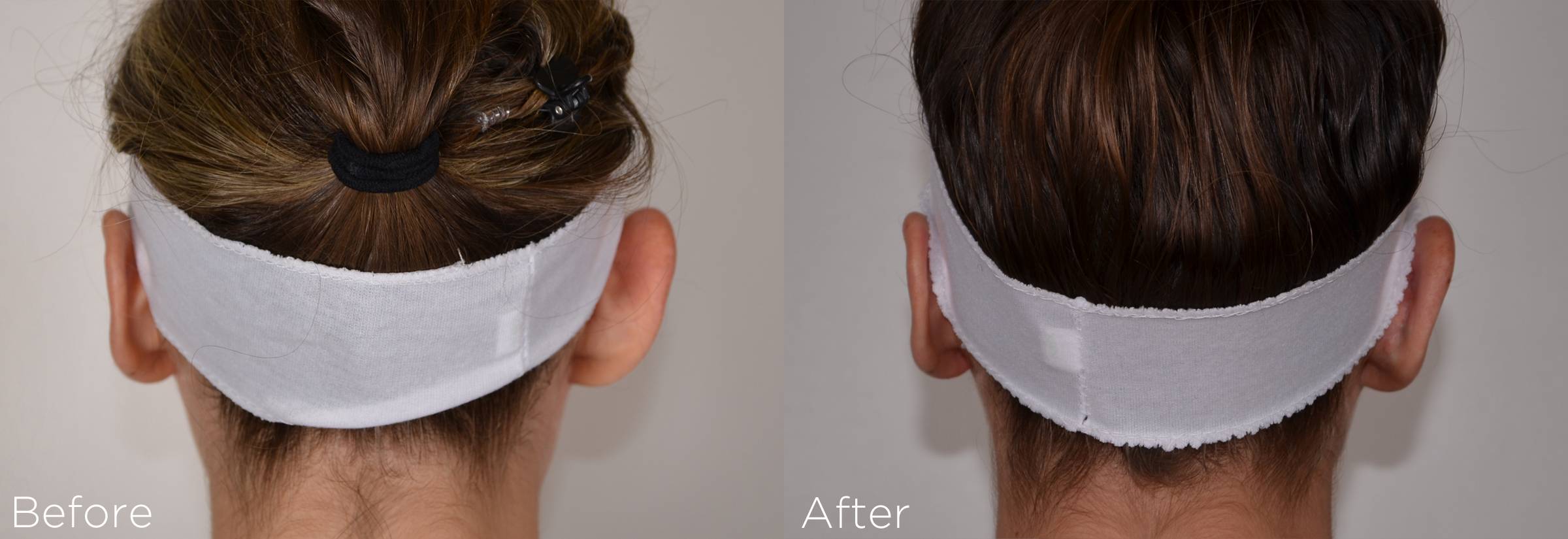 Otoplasty before and after image