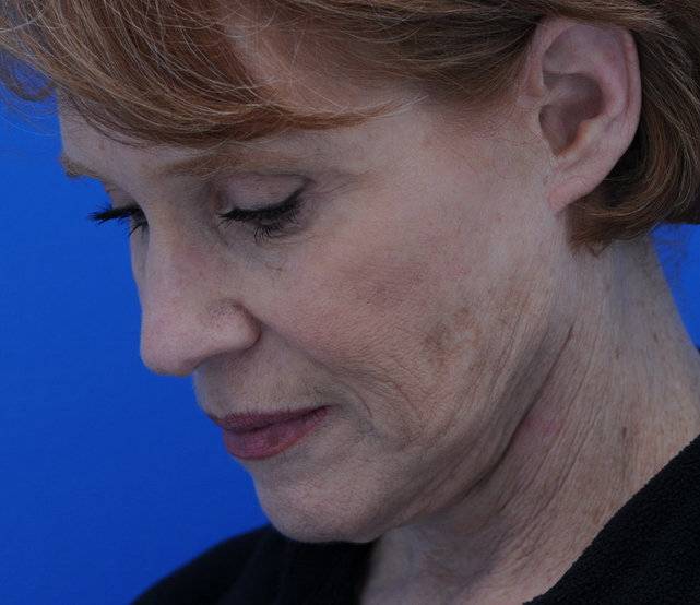 neck lift before