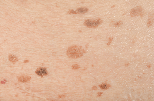 age spots