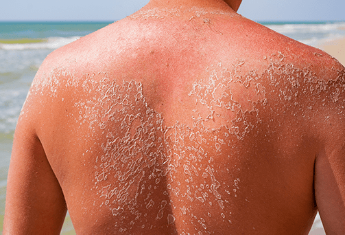 sun burn