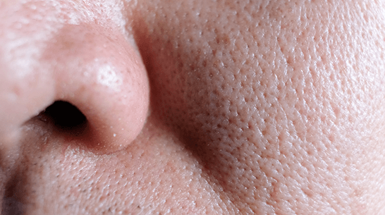 enlarged pores