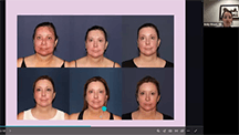 ActiveFX Laser Resurfacing